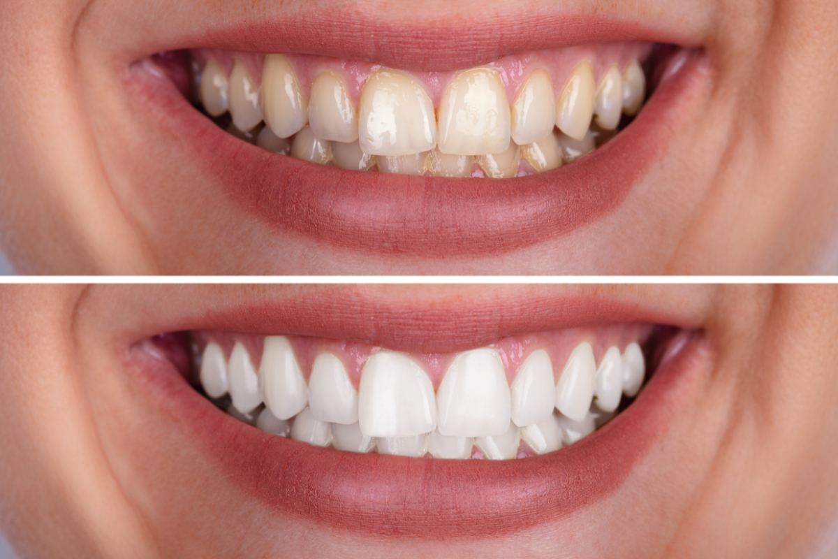 Você já se olhou no espelho e sentiu que seu sorriso poderia estar mais brilhante? Ou comparou com fotos antigas e percebeu que seus dentes escureceram ao longo do tempo? Se sim, o clareamento dental pode ser a solução perfeita para você!