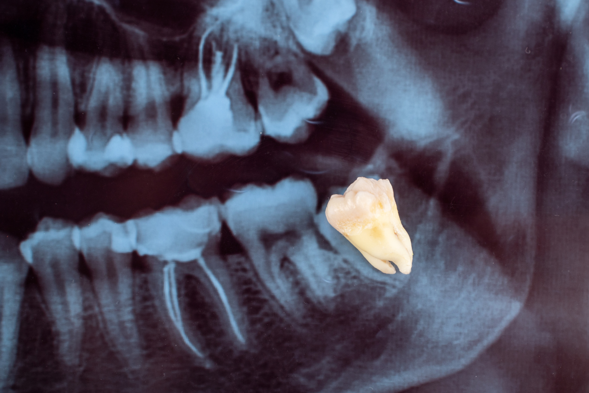 Extração do dente do siso com segurança e sem dor – entenda como funciona o procedimento