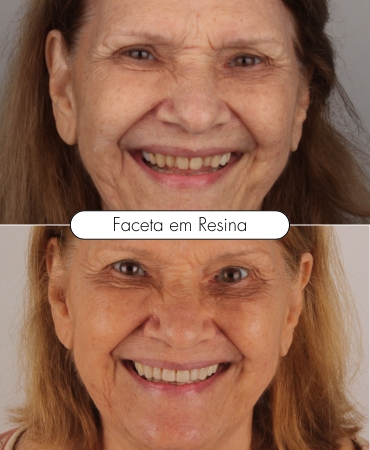 Faceta em resina aplicada por dentista na Ilha do Governador para melhorar a estética dental e deixar o sorriso mais natural e harmonioso.