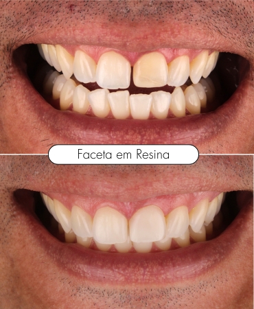 Faceta em resina aplicada por dentista na Ilha do Governador para melhorar a estética dental e deixar o sorriso mais natural e harmonioso.