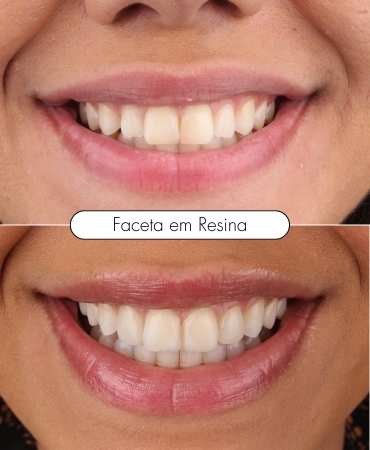 Faceta em resina aplicada por dentista na Ilha do Governador para melhorar a estética dental e deixar o sorriso mais natural e harmonioso.