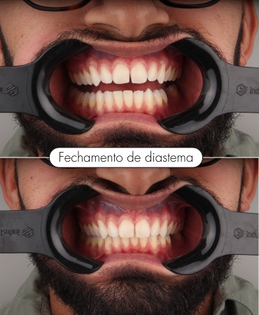 Fechamento de diastema realizado por dentista na Ilha do Governador para corrigir espaço entre os dentes e melhorar a estética do sorriso.
