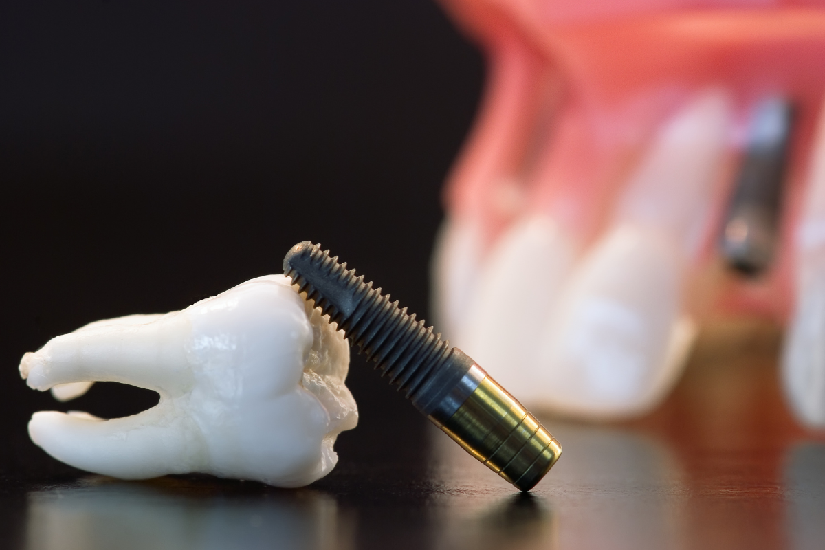 Planejamento digital de implante dentário em software odontológico 3D