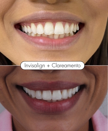 Tratamento de Invisalign combinado com clareamento dental na Ilha do Governador para alinhar os dentes e conquistar um sorriso mais branco e harmônico.