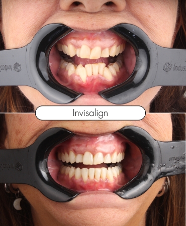 Tratamento com Invisalign na Ilha do Governador para alinhar os dentes de forma discreta e confortável.