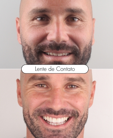 Lentes de contato dental aplicadas por dentista na Ilha do Governador para transformar o sorriso com estética natural.