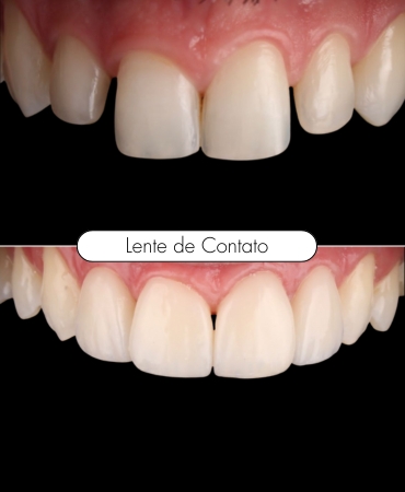 Lente de contato dental na Ilha do Governador para transformar o sorriso com dentes mais brancos, alinhados e harmônicos.
