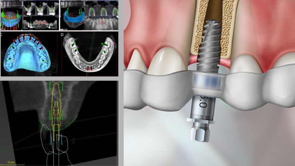 Planejamento digital de implante dentário em software odontológico 3D