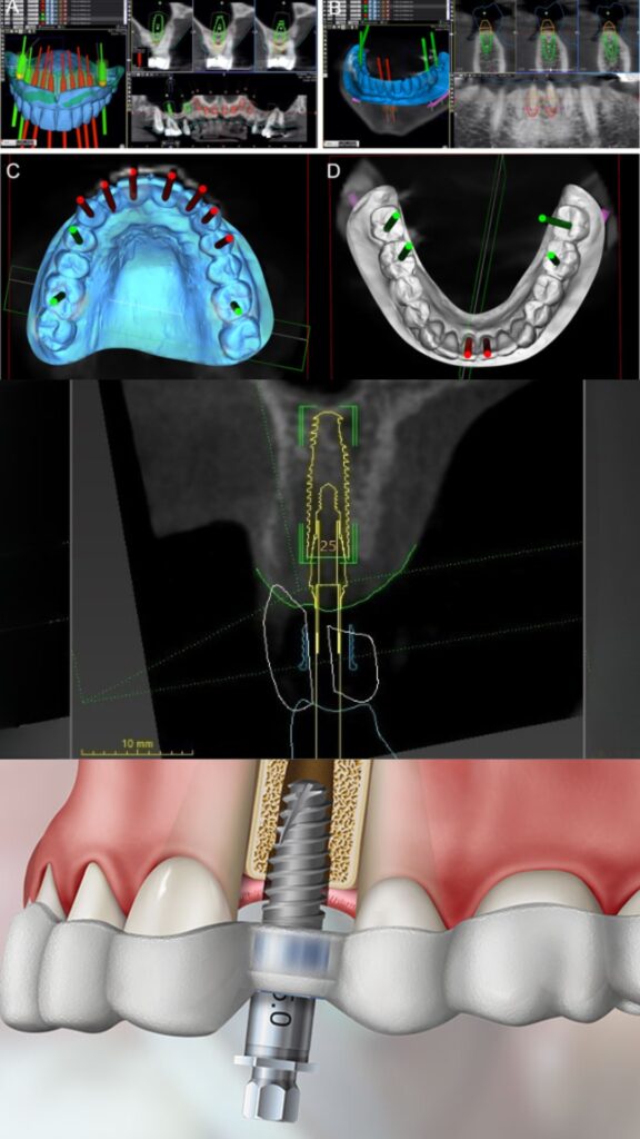 Planejamento digital de implante dentário em software odontológico 3D