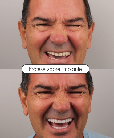 Prótese sobre implante realizada por dentista na Ilha do Governador, devolvendo função mastigatória e estética ao sorriso.