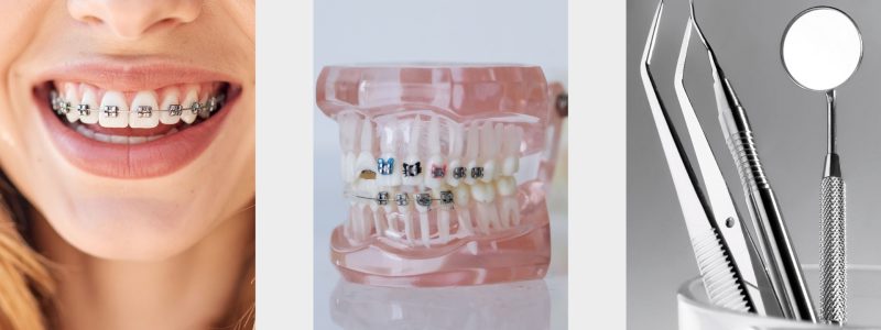 Alinhador invisível Invisalign na Ilha do Governador com planejamento digital
