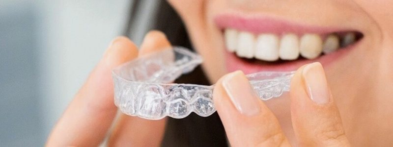 Alinhador invisível Invisalign na Ilha do Governador com planejamento digital